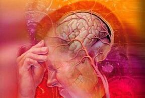 Cervicale migraine syndroom
