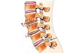 spondylarthrose als de oorzaken van rugpijn