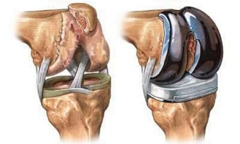 Endoprosthetics van het kniegewricht voor artrose