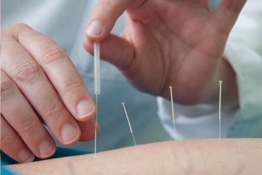 Acupunctuur is een methode voor de behandeling van pijn in de lumbale regio veroorzaakt door osteochondrose