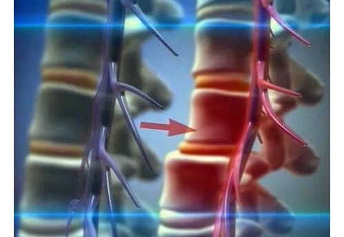 Compressie van zenuwuiteinden bij lumbale osteochondrose