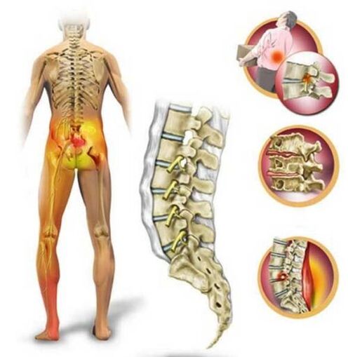 Osteochondrose van de lumbale wervelkolom, waardoor lage rugpijn ontstaat