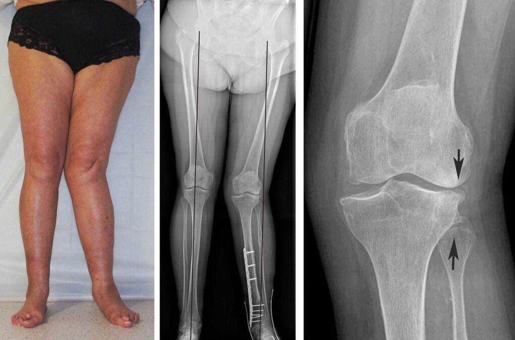 klinisch beeld van artrose in de knie
