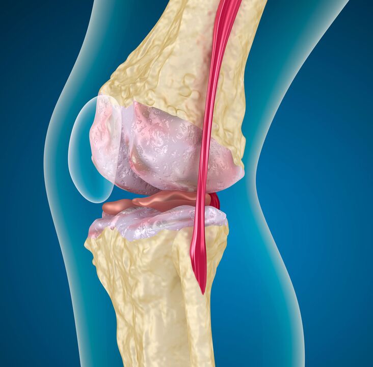Artrose van het kniegewricht - een degeneratieve-dystrofische ziekte