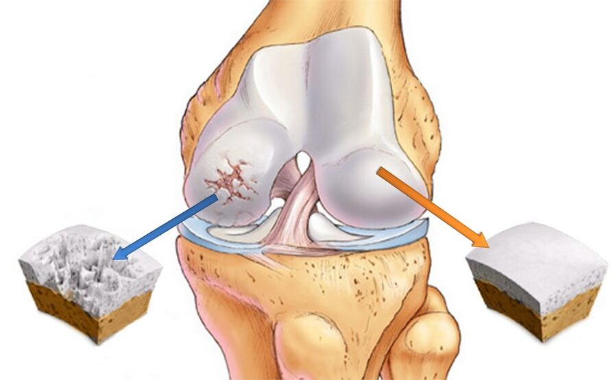Gezond kniegewricht (rechts) en aangetast door artrose (links)