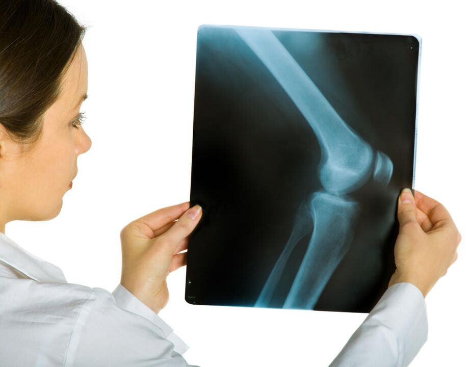 Röntgenfoto van het kniegewricht zal de aanwezigheid van vervormende artrose onthullen